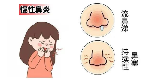 长期鼻炎会导致什么后果，错了！鼻炎的危害以下内容来告诉你!