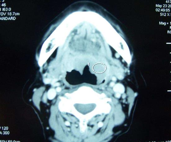 扁桃体癌早期的图片，你知道是什么样的吗？