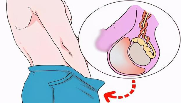 睾丸积液如何护理最有效？