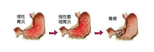 萎缩性胃炎能活多久，抑制增生，控制细胞持续死亡，让存活的细胞更加健康。